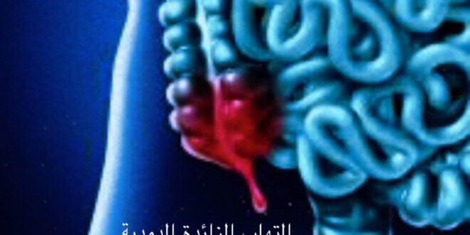 التهاب الزائده الدوديه