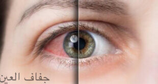 جفاف العيون، شات ايلول ، موقع ايلول جميع للحقوق محفوظة