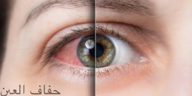 جفاف العيون، شات ايلول ، موقع ايلول جميع للحقوق محفوظة